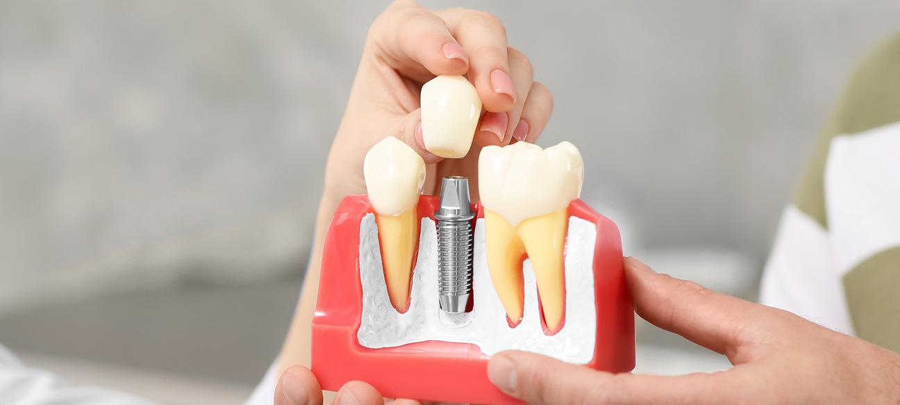 Dental Implants 