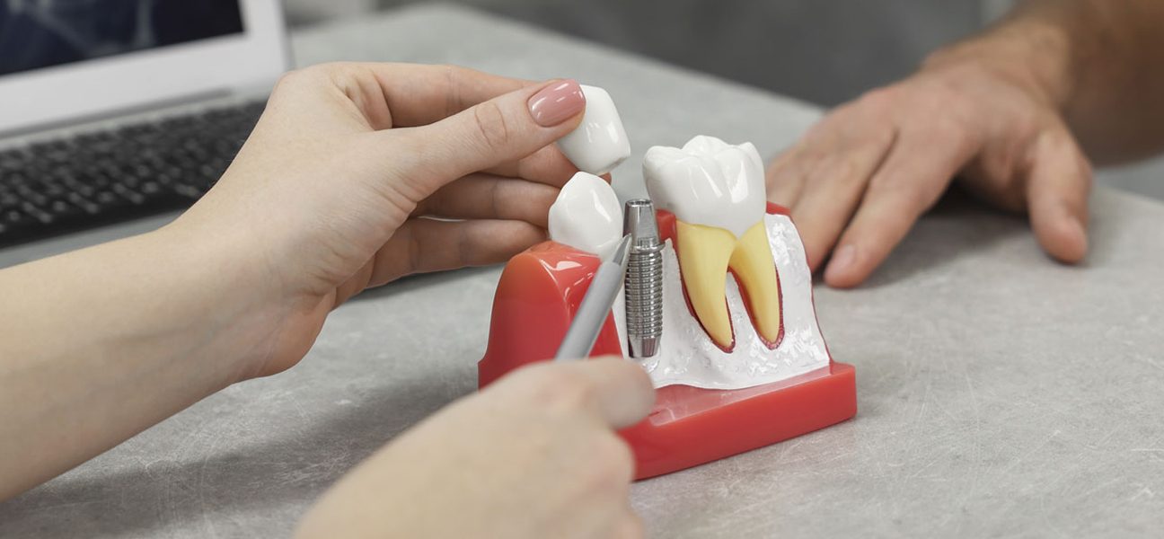 Key Factors for Dental Implant Success in Seniors with Bone Loss