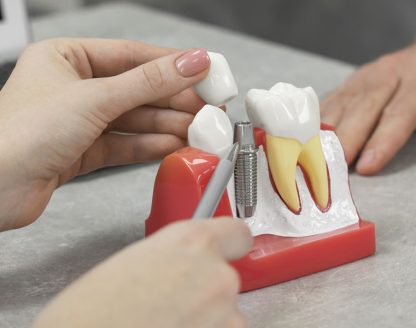 Key Factors for Dental Implant Success in Seniors with Bone Loss 