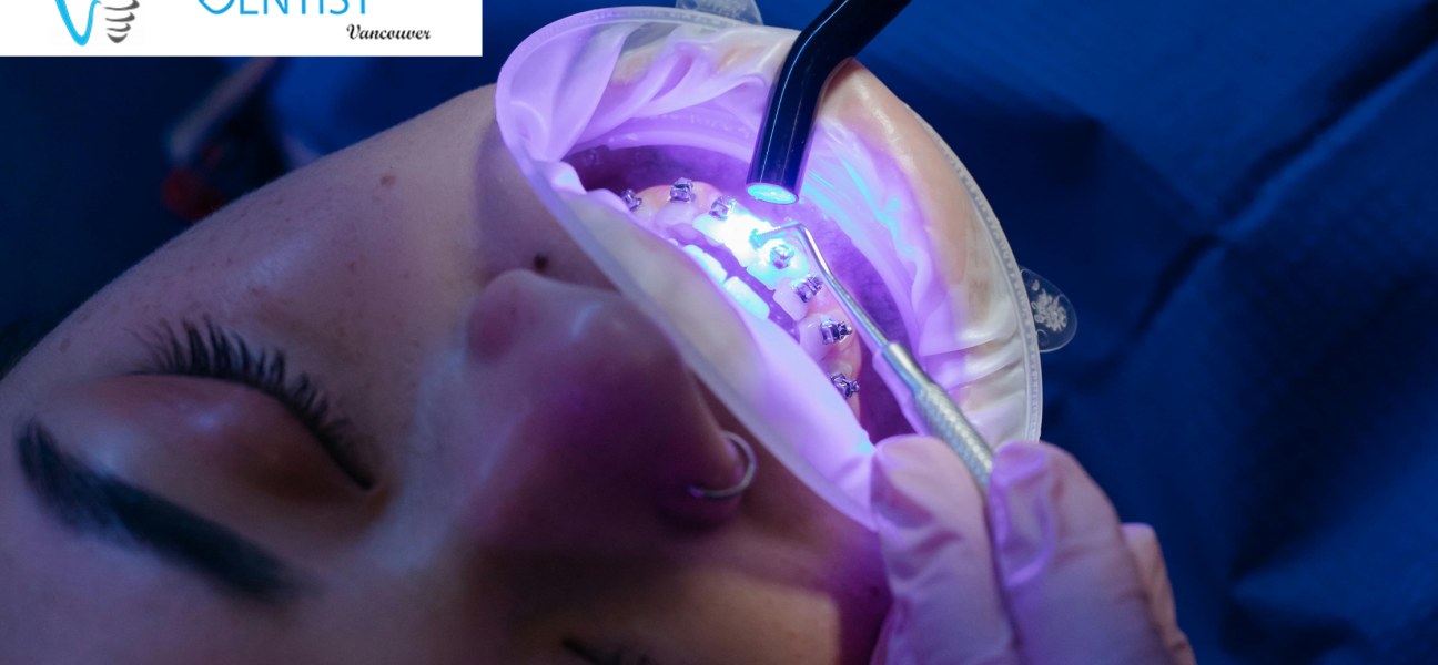 teeth whitening in Vancouver