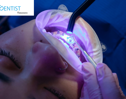 teeth whitening in Vancouver 