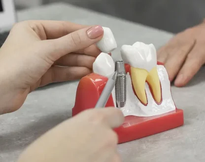 Are You a Candidate for Dental Implants? Factors to Consider Before Treatment 